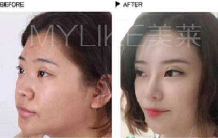 做完鼻整形，顏值逆風(fēng)翻盤！