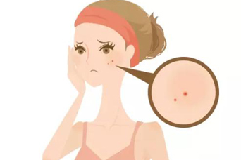 常州復合彩光祛痘印術(shù)后效果好嗎？