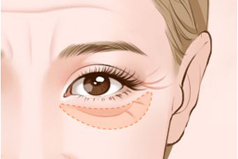 深圳做眼部去脂容易嗎？