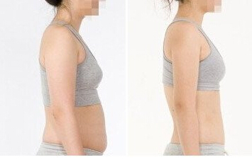 南京吸脂瘦身多少錢？