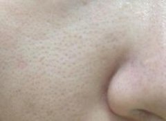 北京面部毛孔粗大怎么辦？