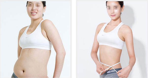 重慶吸脂手術(shù)的價(jià)格是多少？