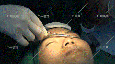 割了5天就有換頭般效果！