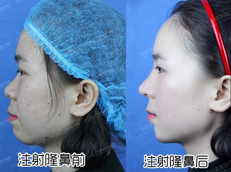 玻尿酸即刻效果多明顯？！