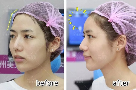 玻尿酸即刻效果多明顯？！