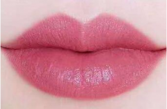 杭州注射玻尿酸豐唇維持多久？