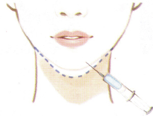 天津注射下巴多少錢(qián)？