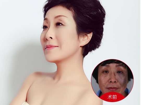 武漢深藍(lán)射頻價(jià)格是多少？