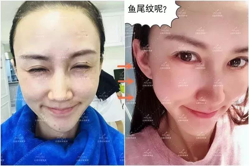 玻尿酸瘦臉打夠次數(shù)就能瘦下來，除皺打夠次數(shù)也能一直保持嗎？