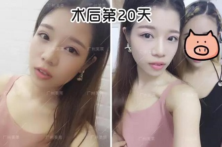 割雙眼皮后都可以出道了！