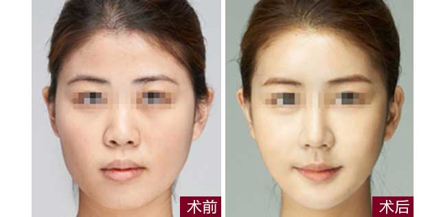 瘦臉一針需要多少錢？