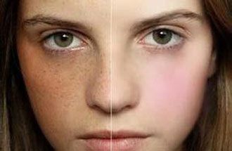 激光祛雀斑需要多少錢(qián)？