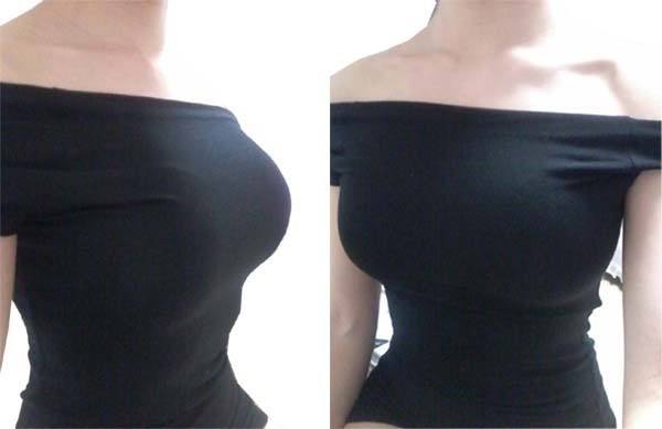假體隆胸前后有什么區(qū)別？