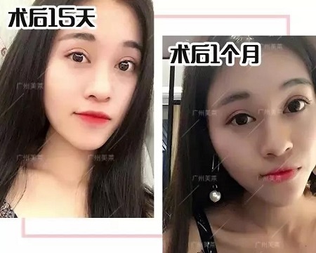 割了雙眼皮能美成啥樣！