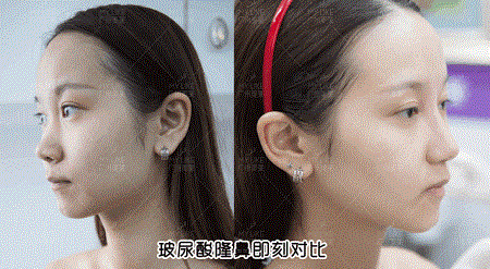 隆鼻價格內幕曝光！水超深！