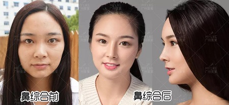 隆鼻價格內幕曝光！水超深！