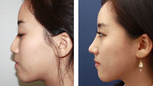 隆鼻手術一般花費是多少？