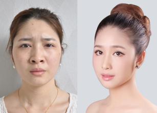 鼻孔縮小術(shù)要多少錢？