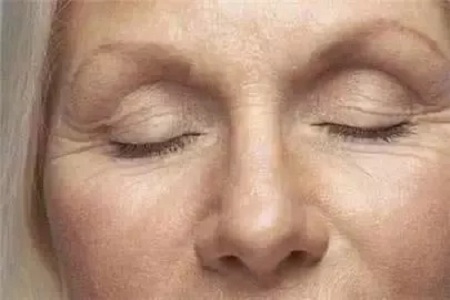 臉部皺紋怎么去除