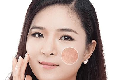 祛黃褐斑的價格大概是多少？