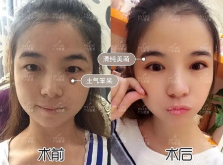 割完雙眼皮氣質(zhì)大變身?。?！