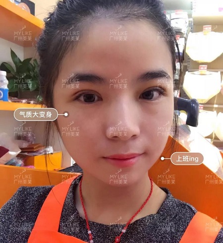 割完雙眼皮氣質(zhì)大變身?。?！