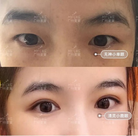 割完雙眼皮氣質(zhì)大變身?。?！