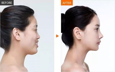  23-24日，韓國較會(huì)整容的柳元敏博士，來了！