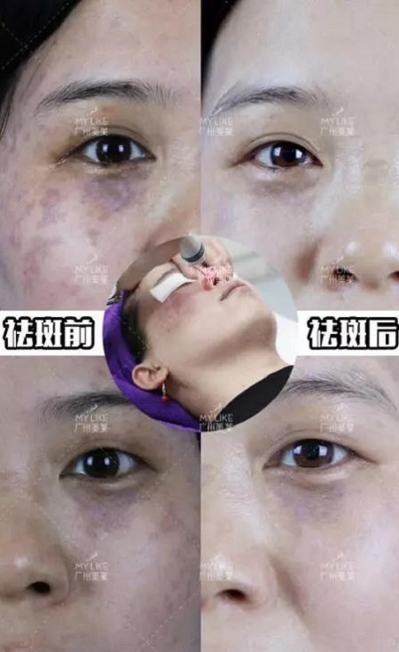 4.14祛斑學(xué)術(shù)盛會(huì)即將啟幕，敬請(qǐng)關(guān)注！