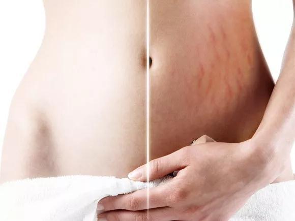 射頻去妊娠紋手術(shù)價格是多少？