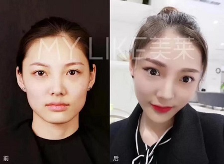 想打瘦臉針，這些事你都了解了嗎？