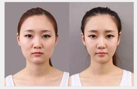 What？瘦臉針還能影響“身高”？