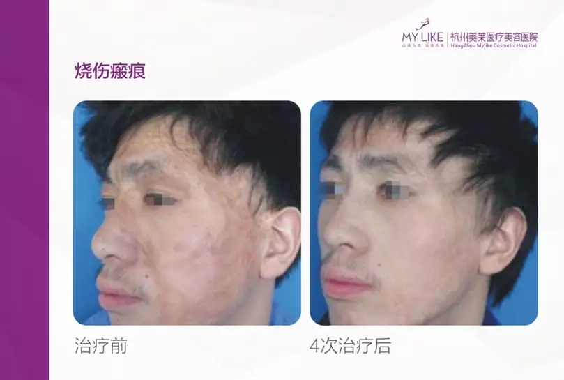 免費皮膚疤痕修復(fù)