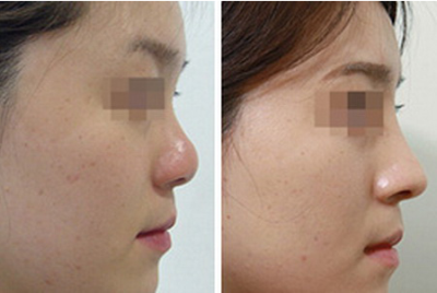 肋軟骨隆鼻多久恢復(fù)好？