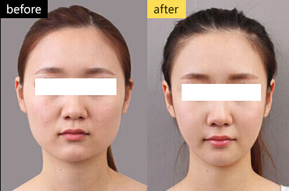 瘦臉的危害有什么？