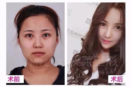 鼻子有這2個(gè)bug，影響顏值又顯老！