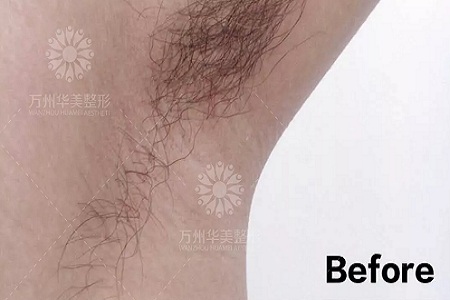 萬人脫毛節(jié)丨脫毛到底要幾次才能脫干凈呢？