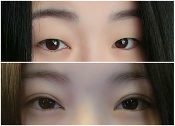 微創(chuàng)雙眼皮手術(shù)要多少錢？