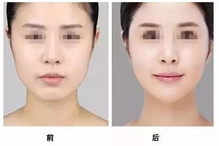 咬肌肥大，醫(yī)師卻不建議我打瘦臉針？