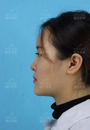 “鼻綜合”后假又歪，還攣縮？鼻修復還原自然生態(tài)美鼻