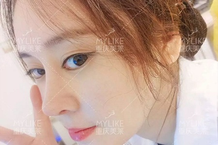 “鼻綜合”后假又歪，還攣縮？鼻修復還原自然生態(tài)美鼻