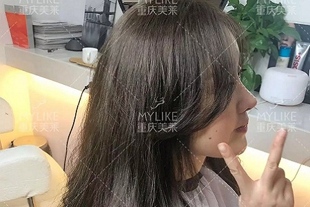 “鼻綜合”后假又歪，還攣縮？鼻修復還原自然生態(tài)美鼻