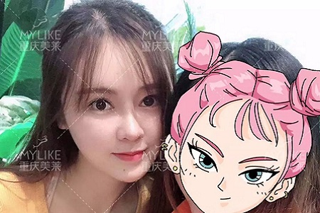 “鼻綜合”后假又歪，還攣縮？鼻修復還原自然生態(tài)美鼻