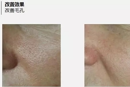 抗衰老的“水光”究竟為何飽受稱贊？