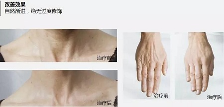 抗衰老的“水光”究竟為何飽受稱贊？