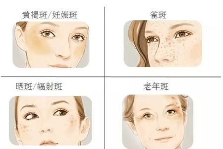 祛斑偏方“害死人”，小仙女們可長(zhǎng)點(diǎn)心吧！