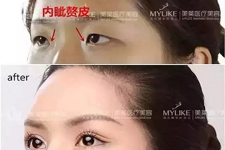 推薦這幾種增大眼睛的方法，除了開外眼角！