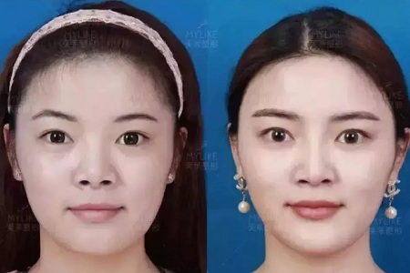 推薦這幾種增大眼睛的方法，除了開外眼角！