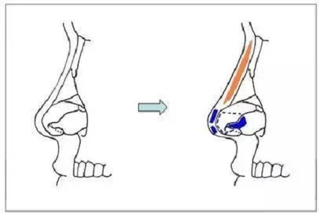 擔心鼻整形假體透光、發(fā)紅、移位？了解下自體軟骨