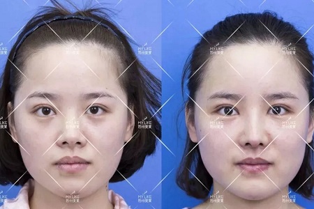 擔心鼻整形假體透光、發(fā)紅、移位？了解下自體軟骨